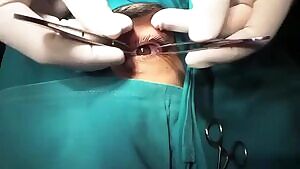 Orbital blowout repair surgery