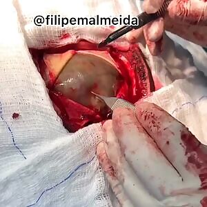 Neurosurgery of Massive Chronic Subdural Hematoma